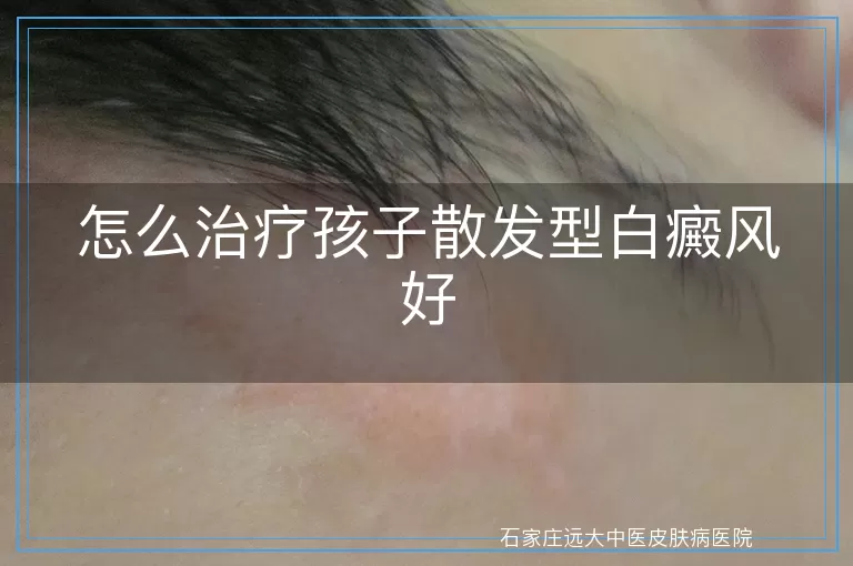 怎么治疗孩子散发型白癜风好