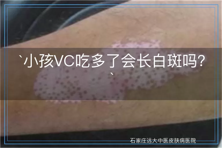 小孩VC吃多了会长白斑吗?