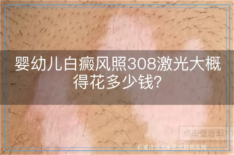 婴幼儿白癜风照308激光大概得花多少钱？