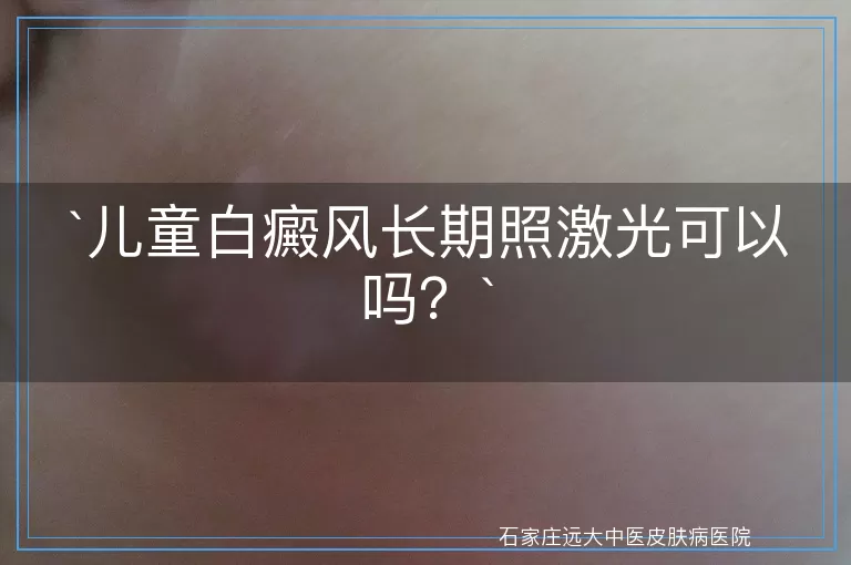 儿童白癜风长期照激光可以吗？