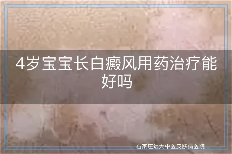 4岁宝宝长白癜风用药治疗能好吗