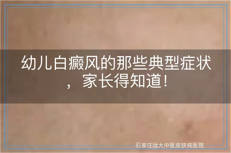 幼儿白癜风的那些典型症状，家长得知道！