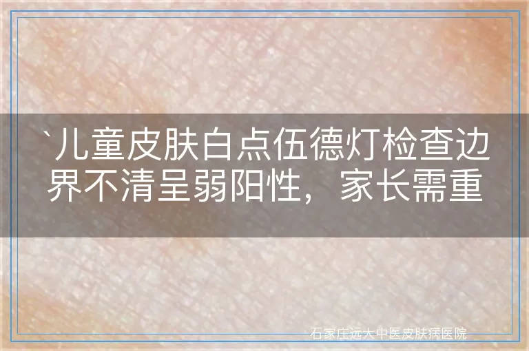 儿童皮肤白点伍德灯检查边界不清呈弱阳性，家长需重视