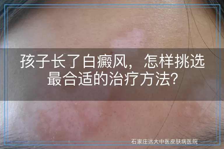 孩子长了白癜风，怎样挑选最合适的治疗方法？