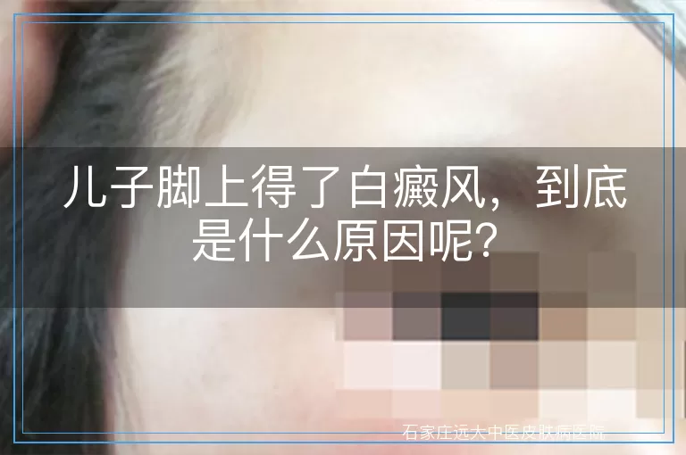 儿子脚上得了白癜风，到底是什么原因呢？