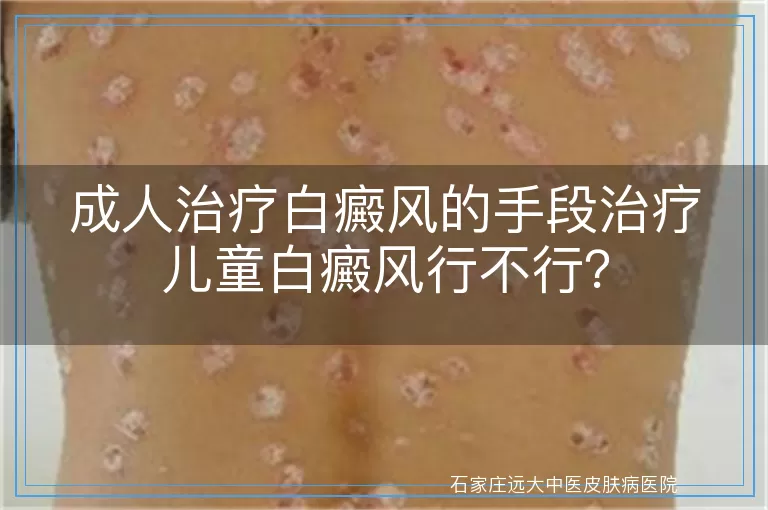 成人治疗白癜风的手段治疗儿童白癜风行不行？