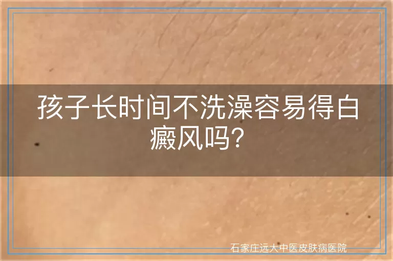 孩子长时间不洗澡容易得白癜风吗？