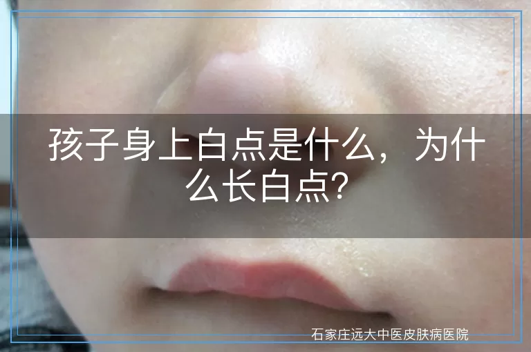 孩子身上白点是什么，为什么长白点？