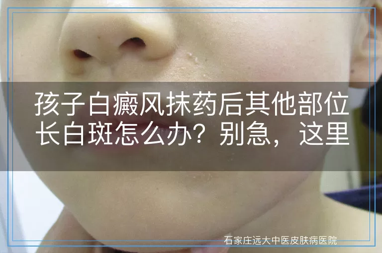 孩子白癜风抹药后其他部位长白斑怎么办？别急，这里有应对策略！