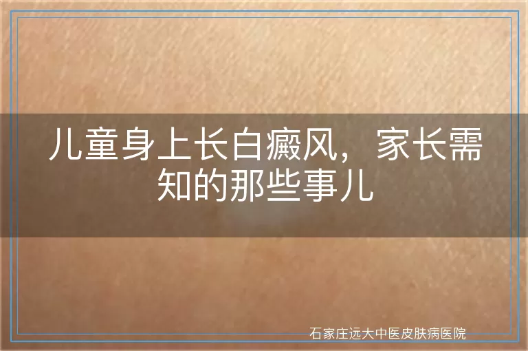 儿童身上长白癜风，家长需知的那些事儿