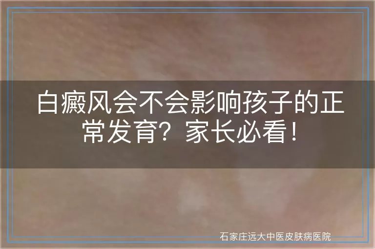 白癜风会不会影响孩子的正常发育？家长必看！