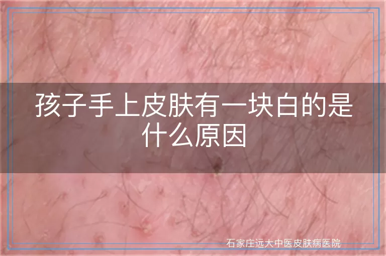 孩子手上皮肤有一块白的是什么原因