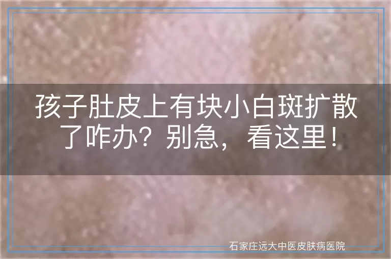 孩子肚皮上有块小白斑扩散了咋办？别急，看这里！