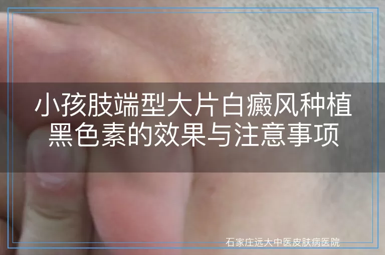 小孩肢端型大片白癜风种植黑色素的效果与注意事项