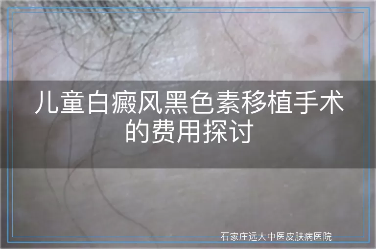 儿童白癜风黑色素移植手术的费用探讨