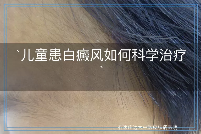 儿童患白癜风如何科学治疗