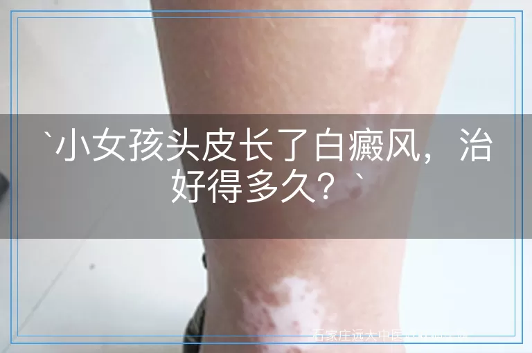 小女孩头皮长了白癜风，治好得多久？