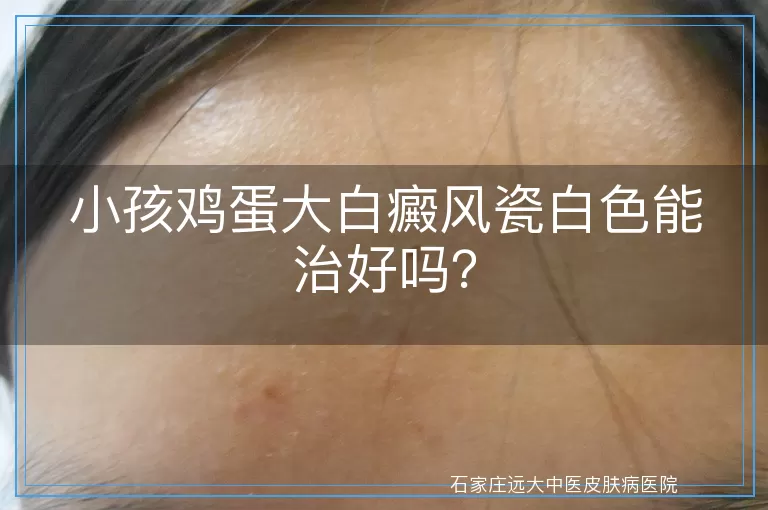小孩鸡蛋大白癜风瓷白色能治好吗？