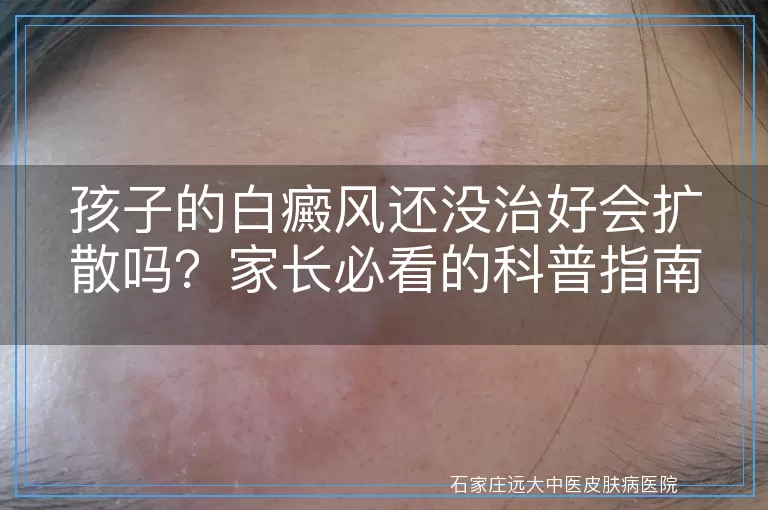 孩子的白癜风还没治好会扩散吗？家长必看的科普指南