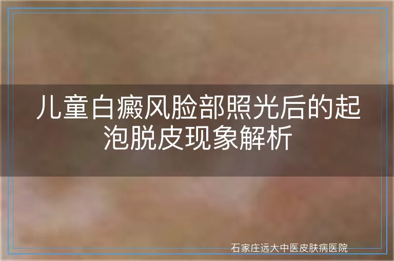 儿童白癜风脸部照光后的起泡脱皮现象解析