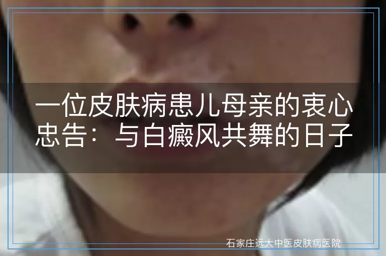一位皮肤病患儿母亲的衷心忠告：与白癜风共舞的日子