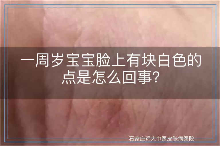 一周岁宝宝脸上有块白色的点是怎么回事？