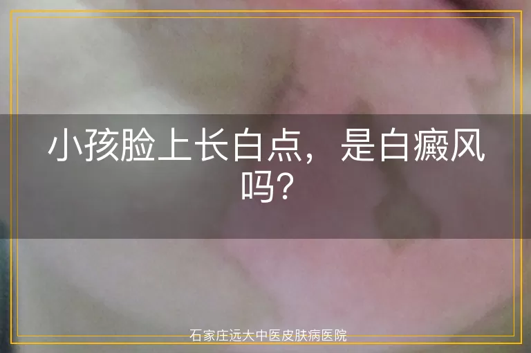 小孩脸上长白点，是白癜风吗？