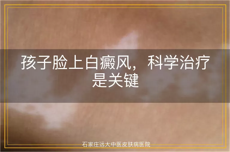 孩子脸上白癜风，科学治疗是关键