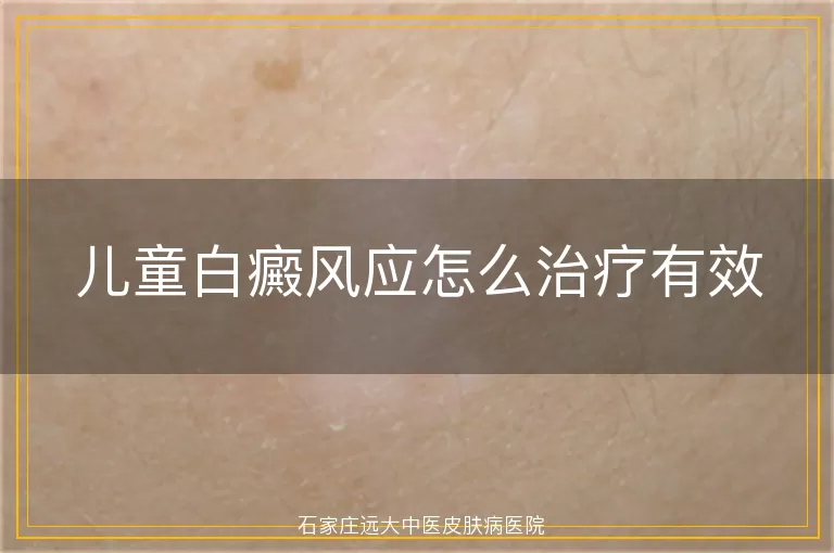 儿童白癜风应怎么治疗有效
