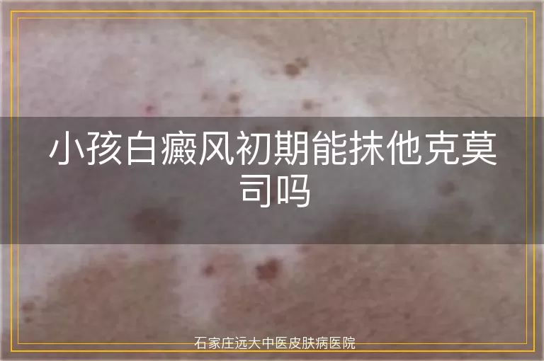 小孩白癜风初期能抹他克莫司吗