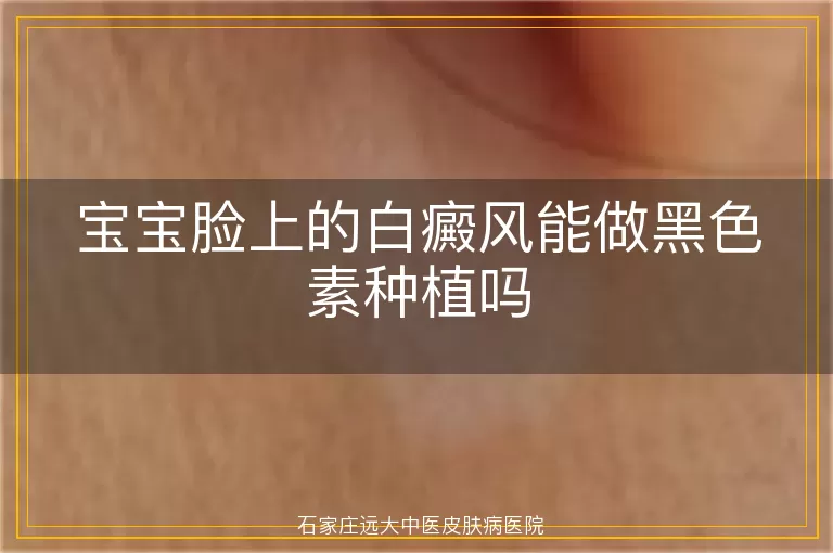 宝宝脸上的白癜风能做黑色素种植吗