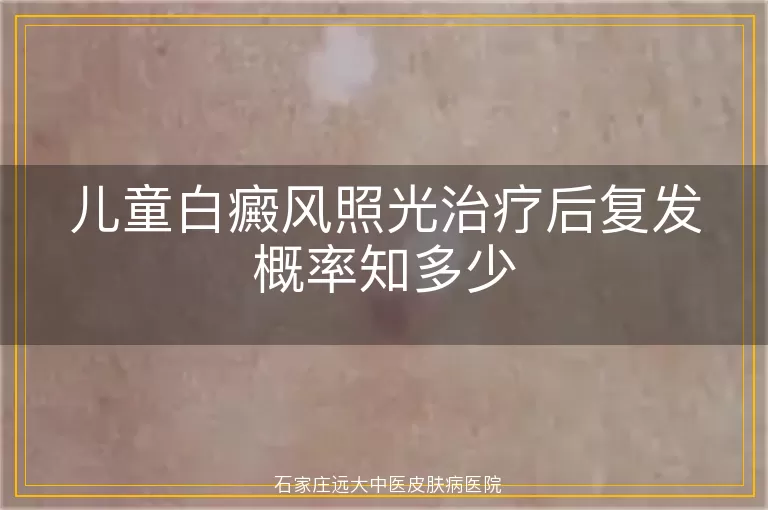 儿童白癜风照光治疗后复发概率知多少