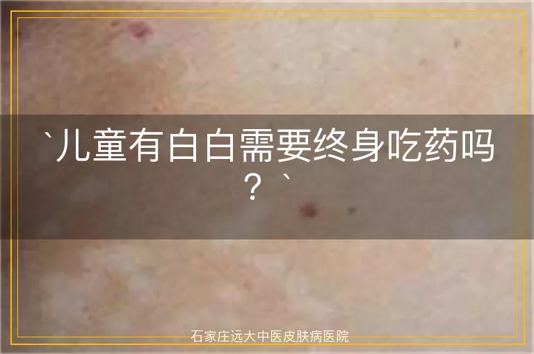 儿童有白白需要终身吃药吗？