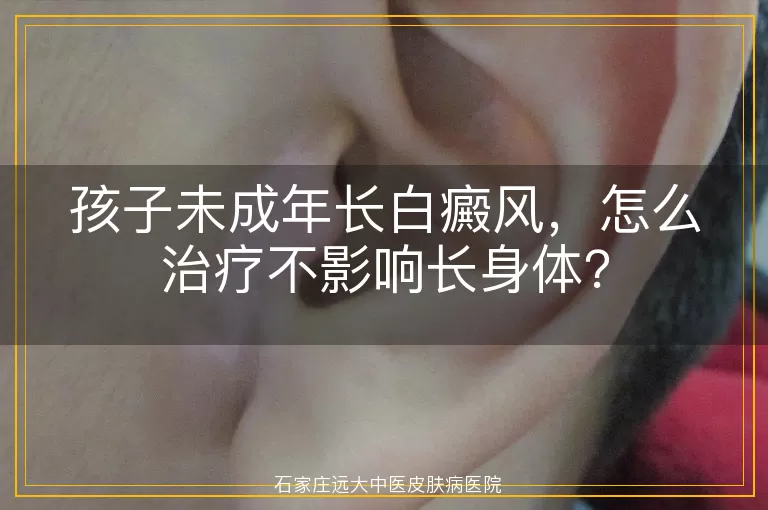 孩子未成年长白癜风，怎么治疗不影响长身体？