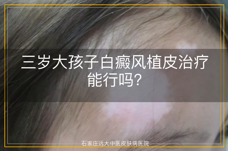 三岁大孩子白癜风植皮治疗能行吗？