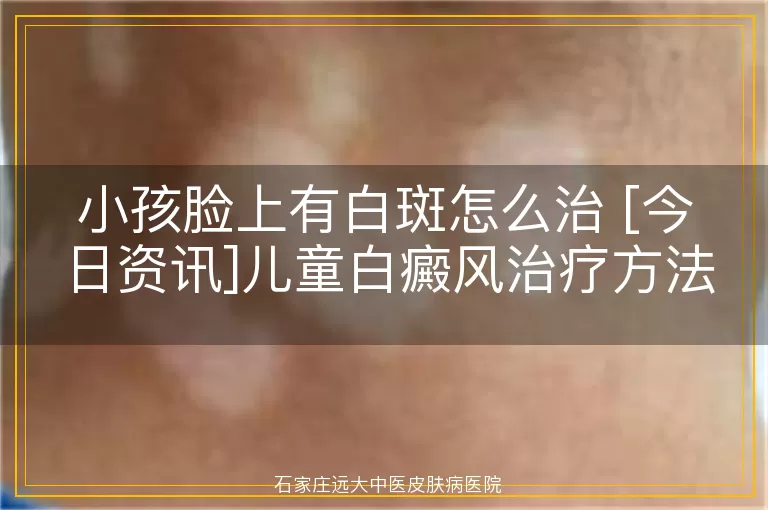 小孩脸上有白斑怎么治 [今日资讯]儿童白癜风治疗方法