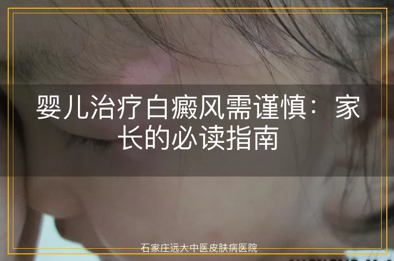 婴儿治疗白癜风需谨慎：家长的必读指南