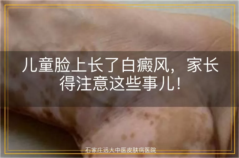 儿童脸上长了白癜风，家长得注意这些事儿！