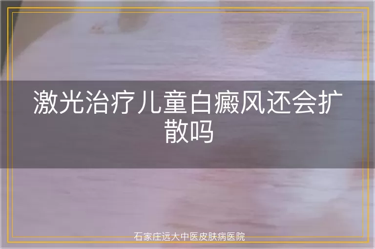 激光治疗儿童白癜风还会扩散吗