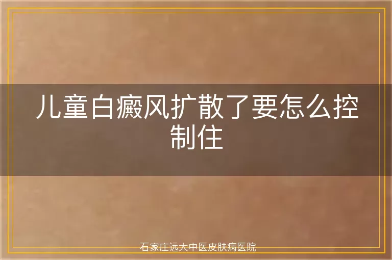 儿童白癜风扩散了要怎么控制住