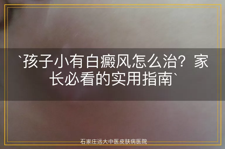 孩子小有白癜风怎么治？家长必看的实用指南