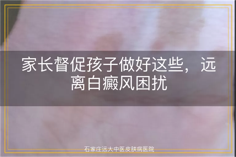 家长督促孩子做好这些，远离白癜风困扰