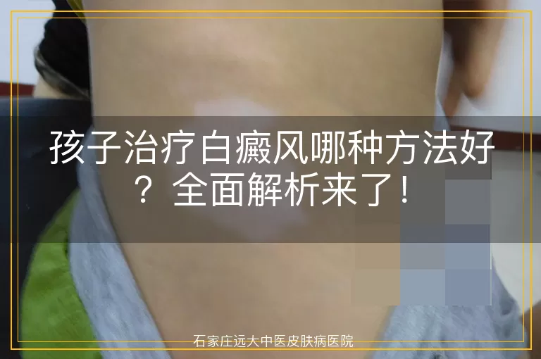 孩子治疗白癜风哪种方法好？全面解析来了！