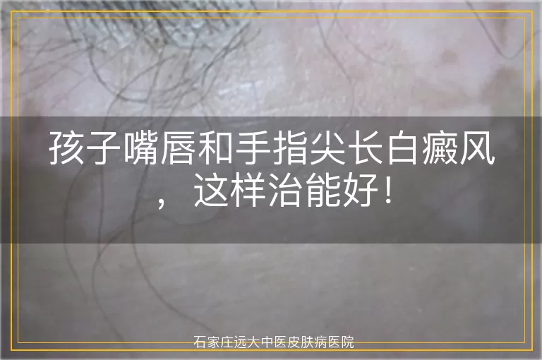孩子嘴唇和手指尖长白癜风，这样治能好！