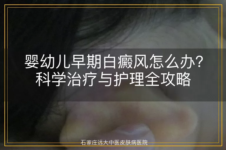 婴幼儿早期白癜风怎么办？科学治疗与护理全攻略