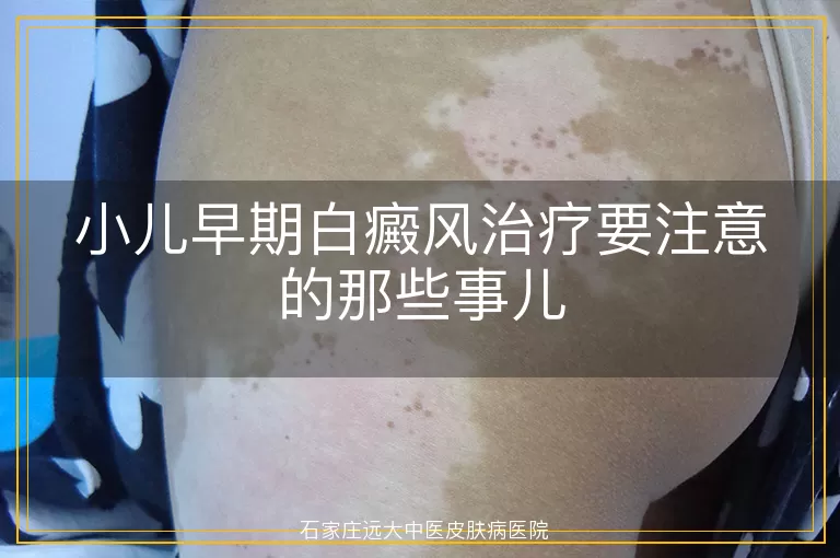 小儿早期白癜风治疗要注意的那些事儿