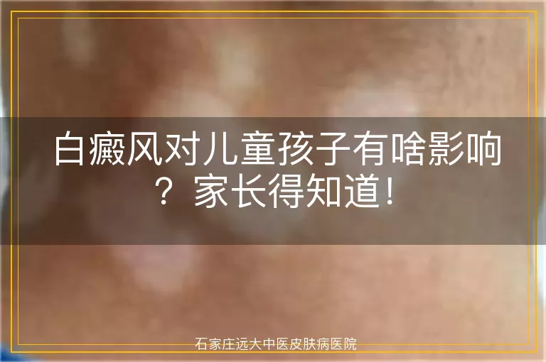 白癜风对儿童孩子有啥影响？家长得知道！