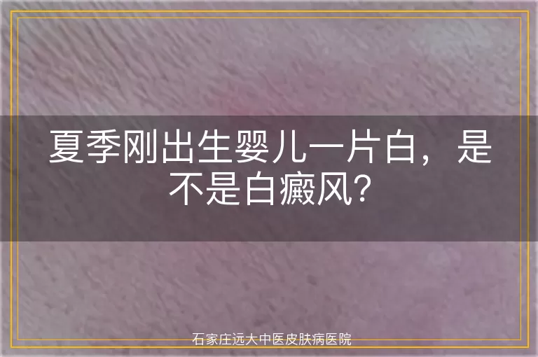 夏季刚出生婴儿一片白，是不是白癜风？