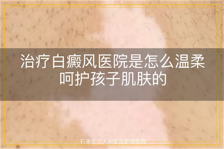 治疗白癜风医院是怎么温柔呵护孩子肌肤的