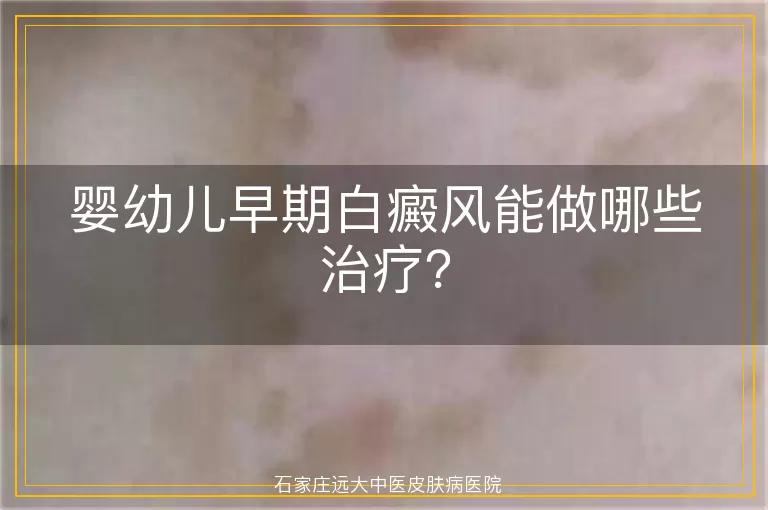 婴幼儿早期白癜风能做哪些治疗？